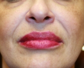 Feel Beautiful - Filler in creases around lips - Before Photo